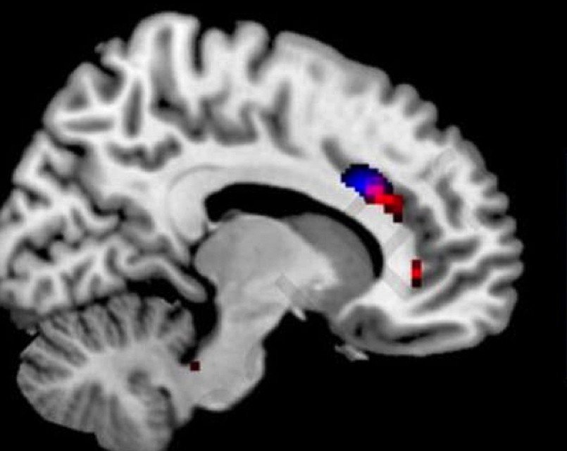 Мозг: синим отмечен нормальный объем серого вещества в конкретном участке, красным - у зависимых. У зависимых серого вещества заметно меньше. 
